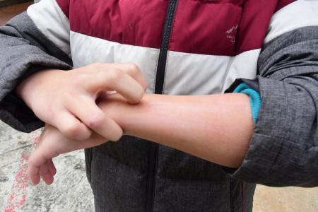 馬祖天候乾冷，冬季癢患者增多　醫師提供日常保濕三招